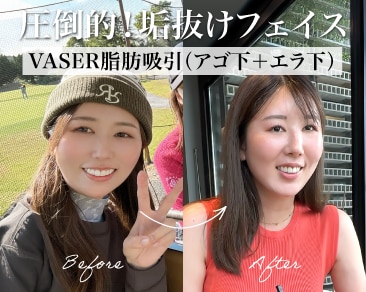 【神奈川・小田原】顔の脂肪吸引のダウンタイムはいつまで?湘南美容クリニック小田原院・谷口院長が術後1ヶ月のリアルな経過を徹底解説!