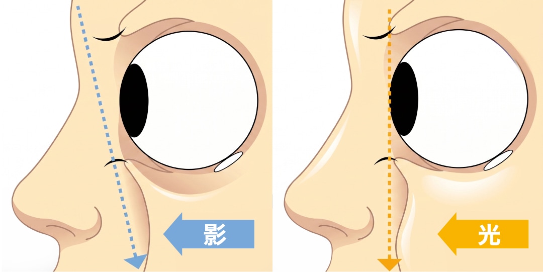 目の下のたるみ・クマの正体は、眼球を支えている「眼窩脂肪」が前に押し出されてきたもの