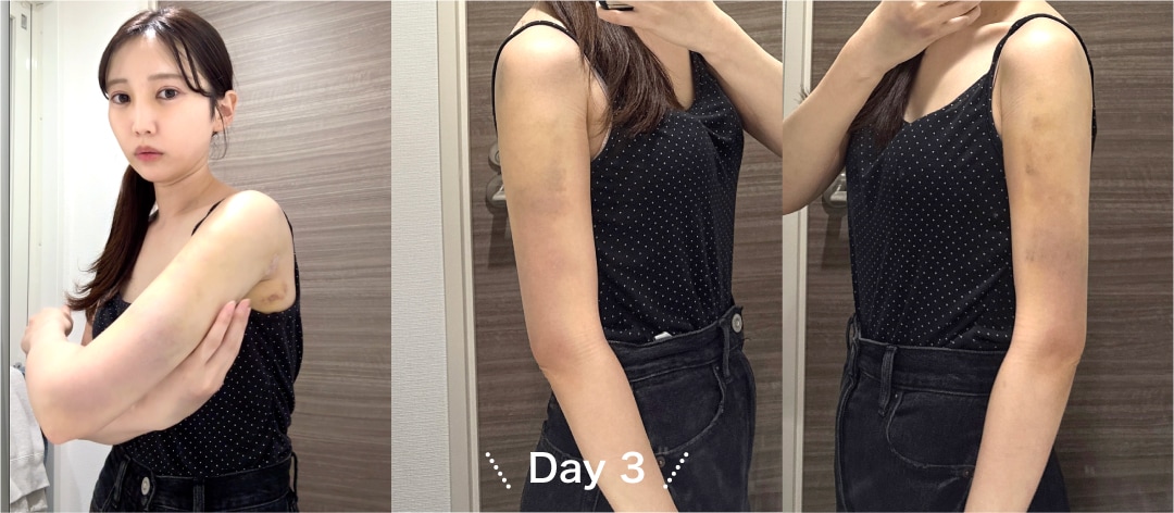 Day 3（術後3日目）「今日から仕事復帰！」
