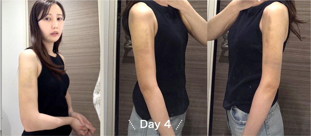 Day 4〜Day 6（術後4〜6日目）「むくみが下に降りてきた」
