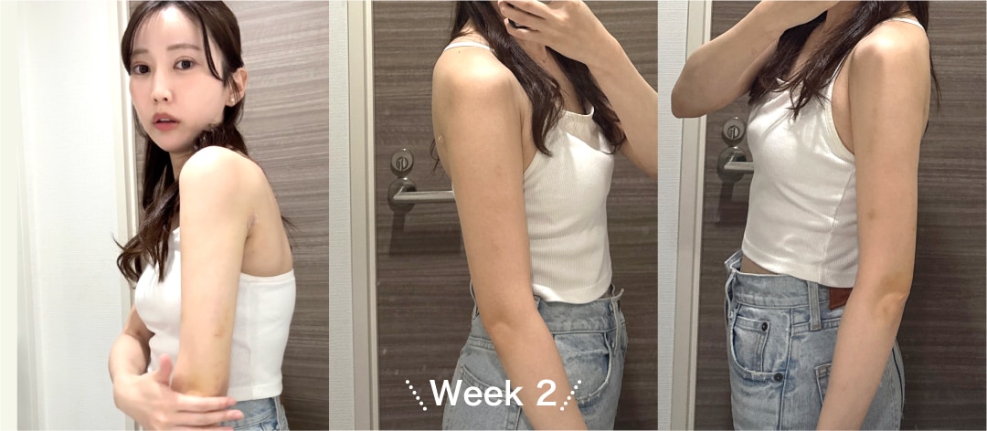 Week 2（術後2週間）「拘縮（こうしゅく）のスタート」