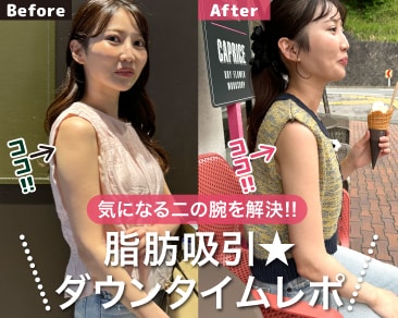 【二の腕脂肪吸引】ダウンタイムのリアルな経過を完全公開!ノースリーブをキレイに着こなす!|小田原院