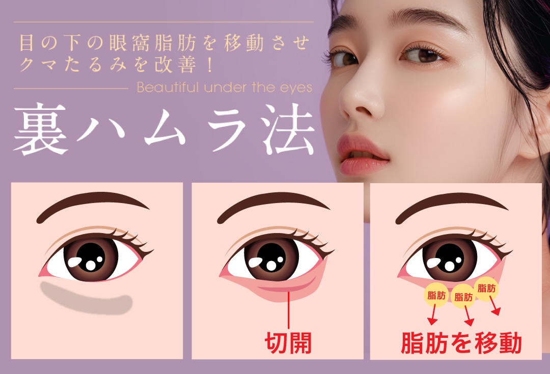 脂肪を温存・移動させる「裏ハムラ法」
