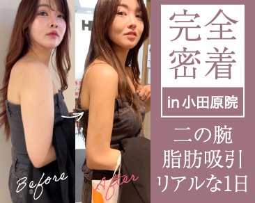 【完全密着】二の腕脂肪吸引の当日の流れを大公開！事前準備・服装・神デザイン〜1ヶ月後の劇的変化まで徹底解説【湘南美容クリニック小田原院】