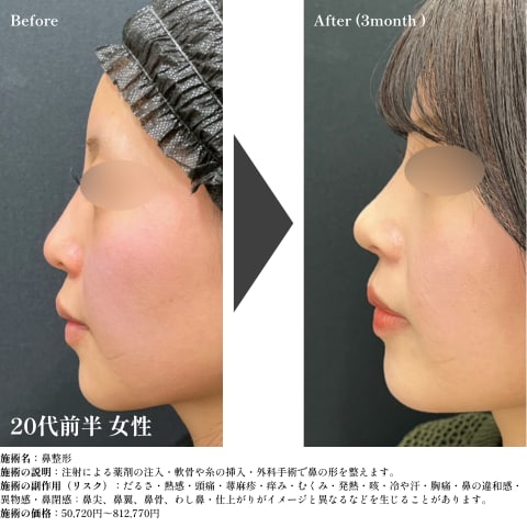 鼻尖形成3D法+鼻尖部軟骨移植