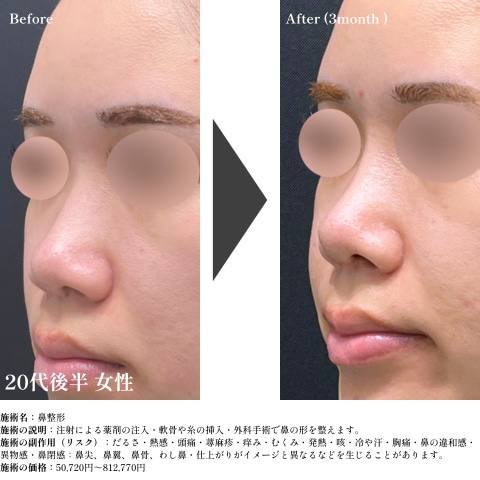 鼻尖形成術+鼻尖部軟骨移植+プロテーゼ