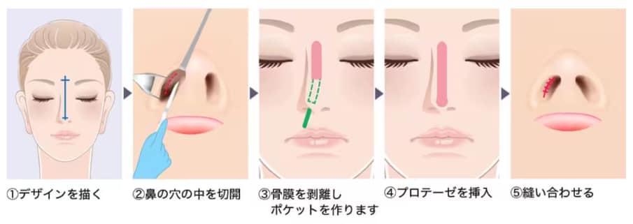SBCプレミアムソフトプロテーゼ(隆鼻術)