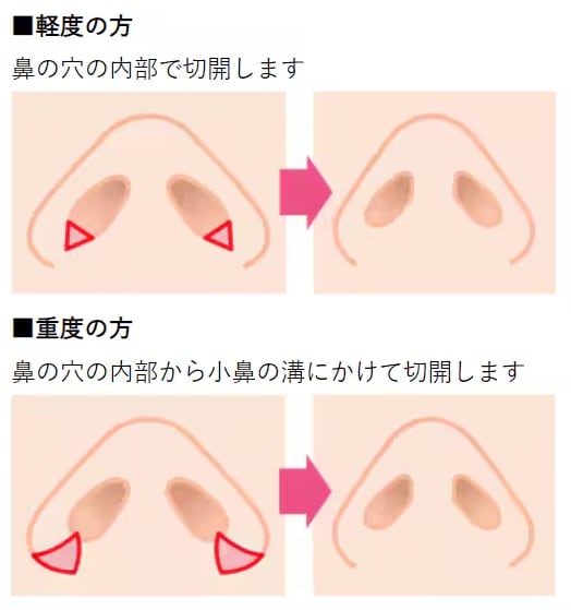 小鼻縮小術(内側法)