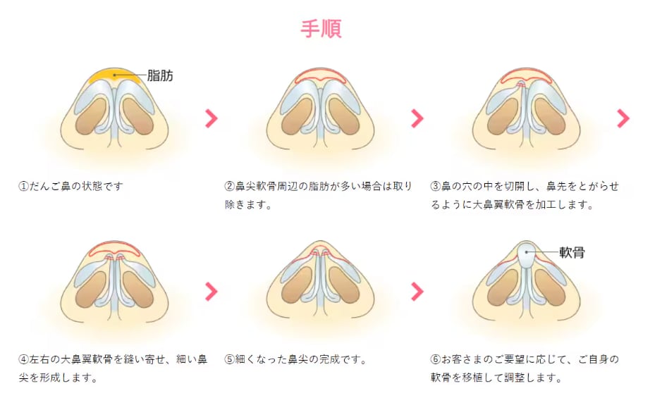 鼻尖形成(だんご鼻解消術)