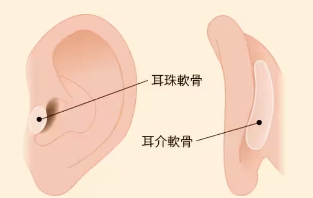 鼻尖部軟骨移植(鼻への耳軟骨移植)