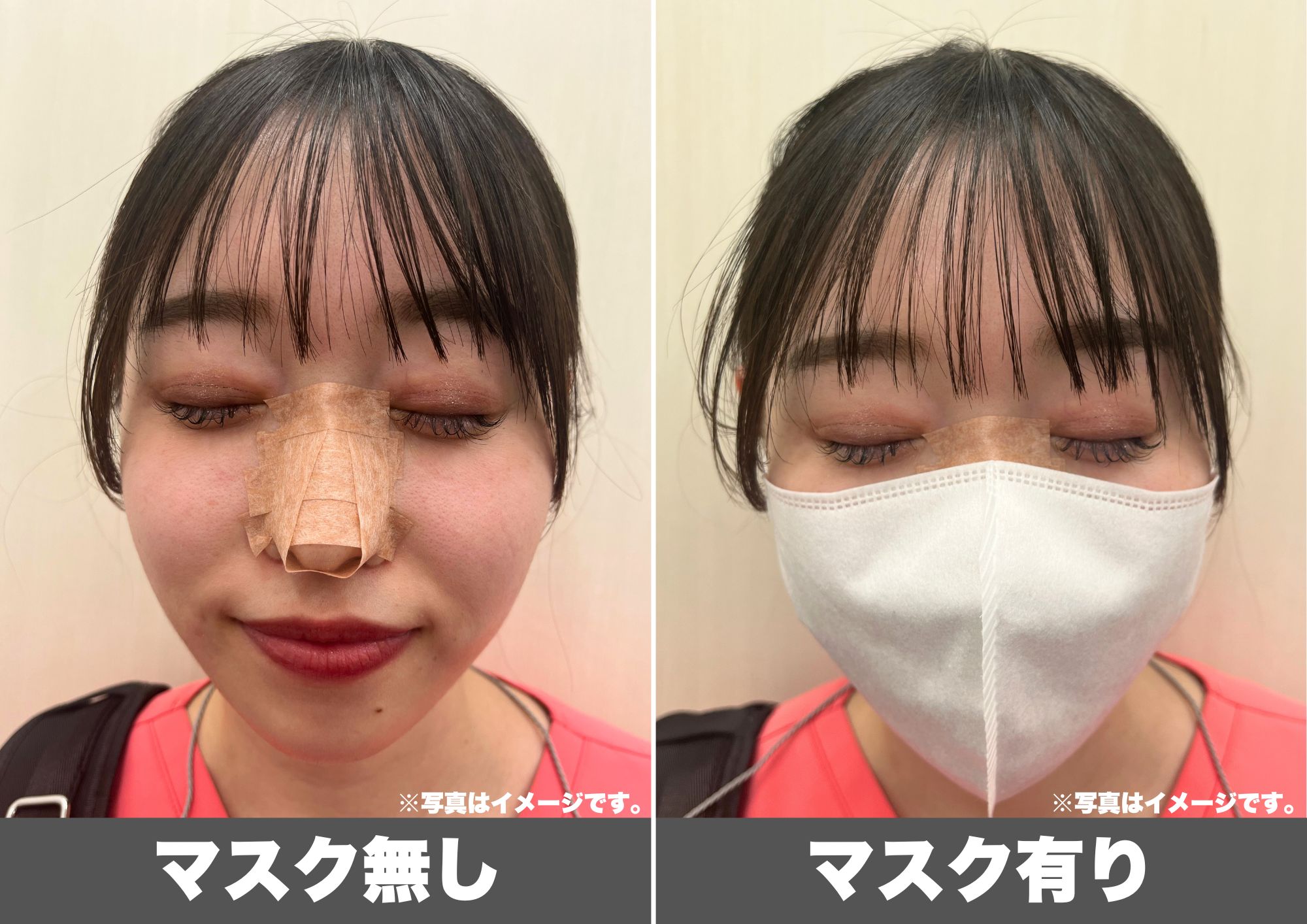 鼻整形後のギブス固定について