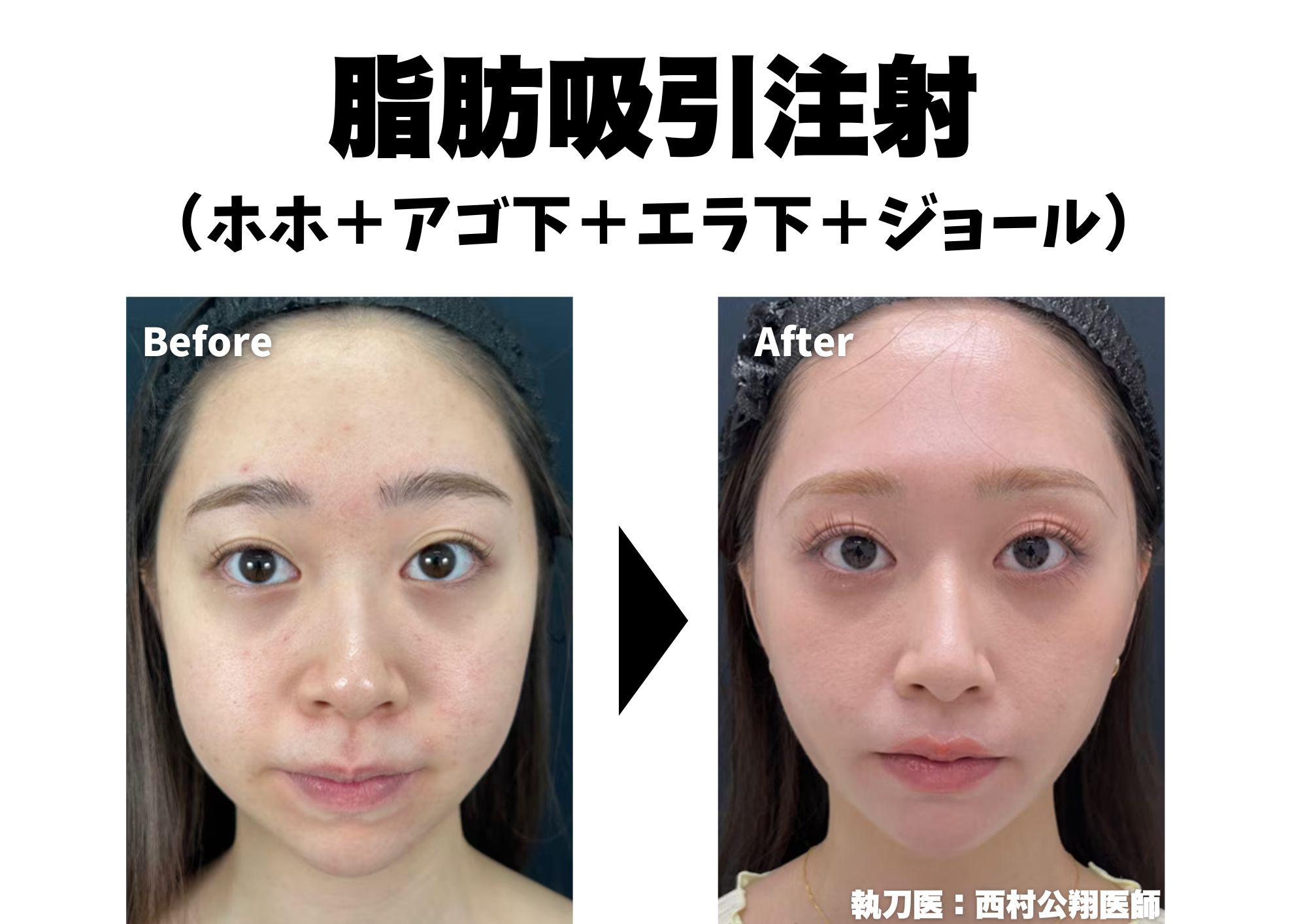 顔の脂肪吸引