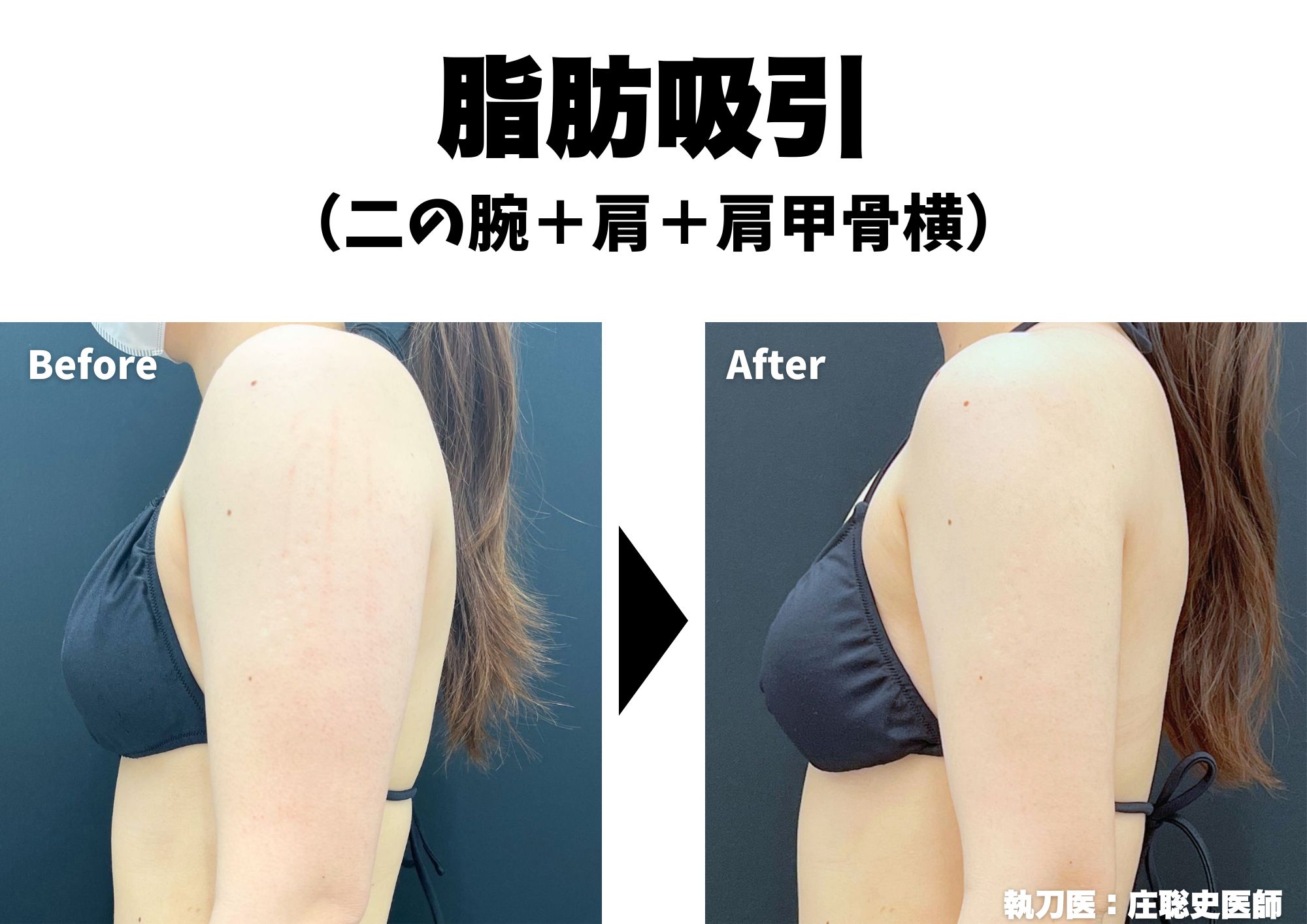 身体の脂肪吸引