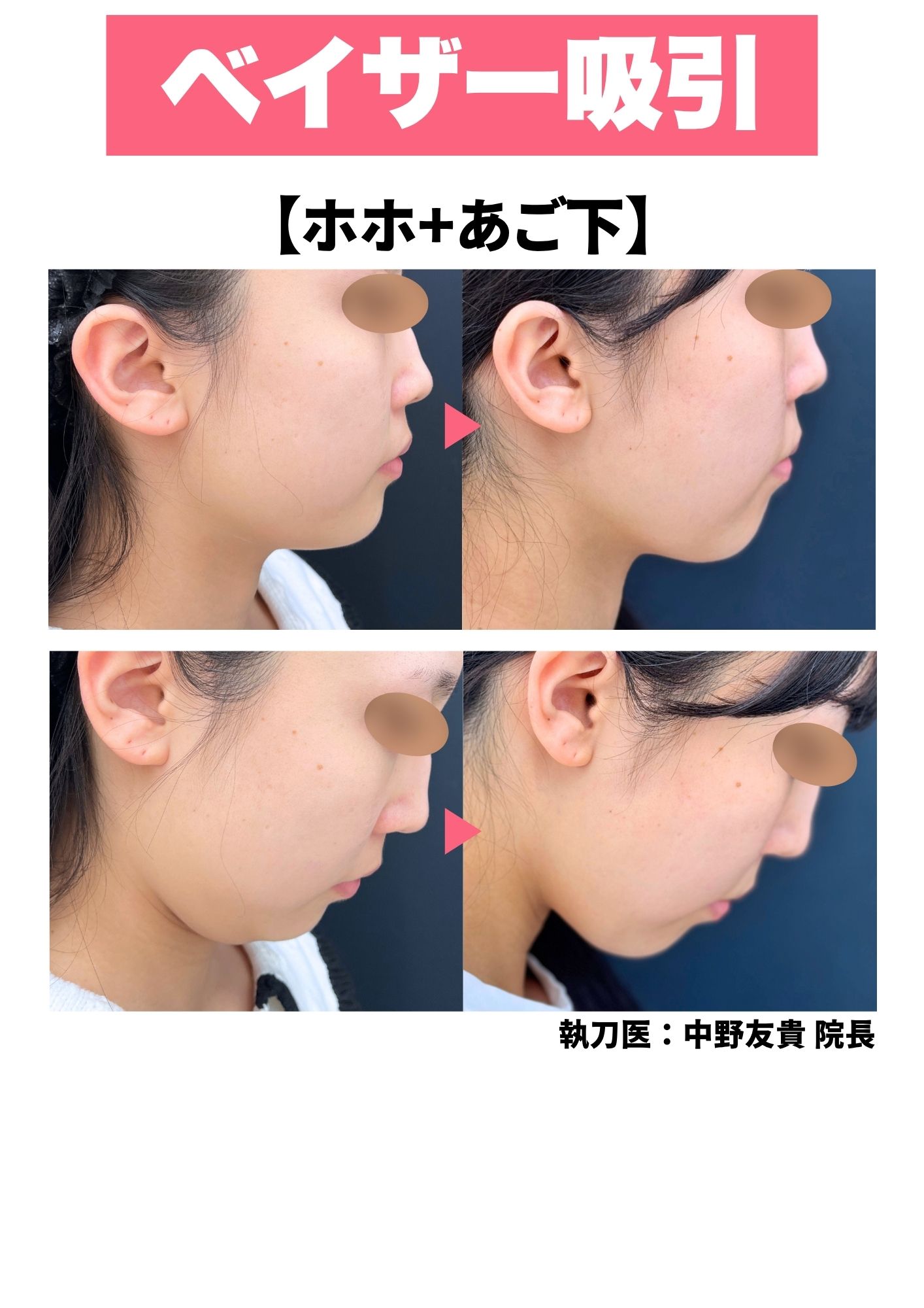 ベイザー脂肪吸引