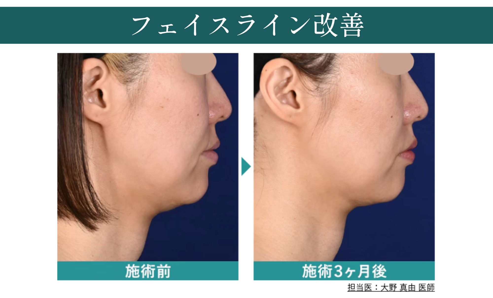 これがデンシティの効果！