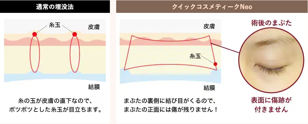 クイックコスメティーク・ダブルNeo