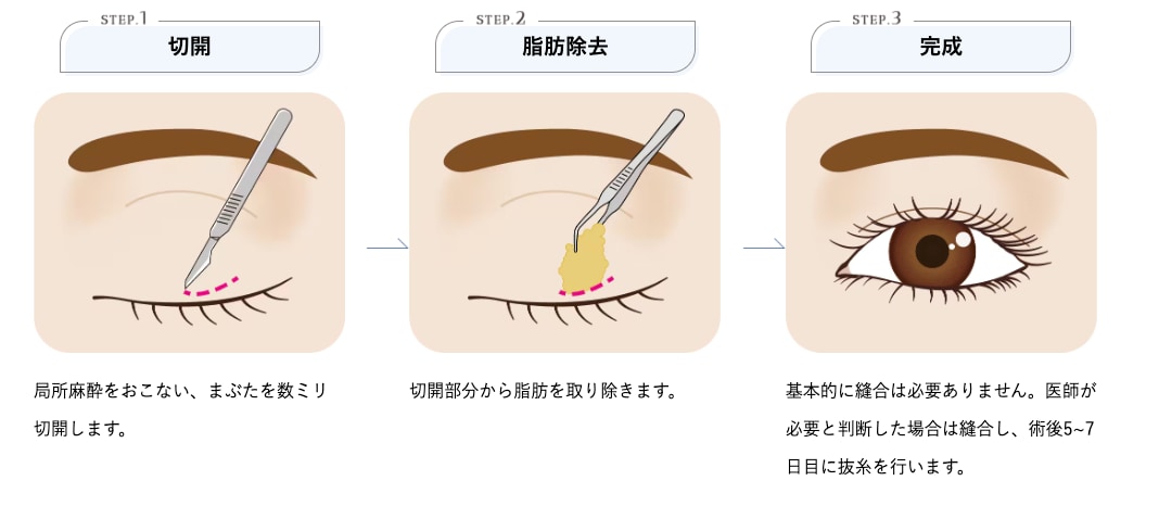 自然癒着セット