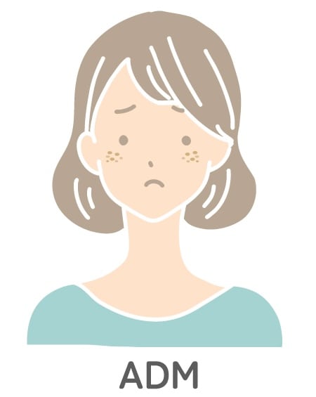ADM（後天性真皮メラノサートス）