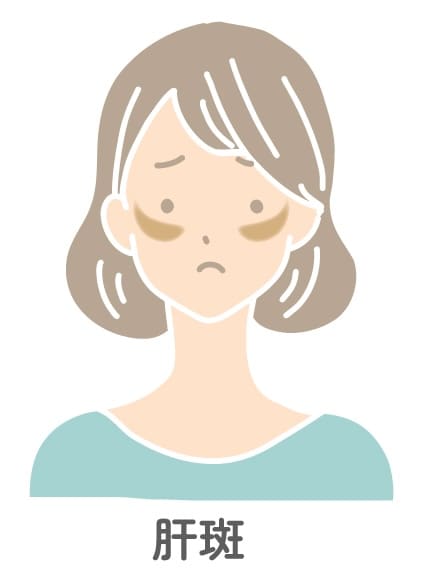 肝斑