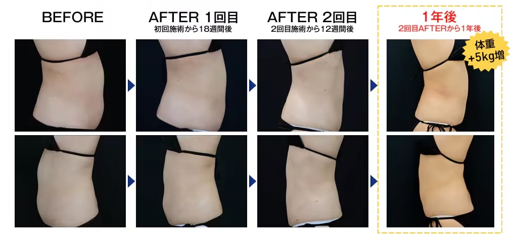 脂肪冷却で脂肪細胞自体の数を減らすから「リバウンド」なし！