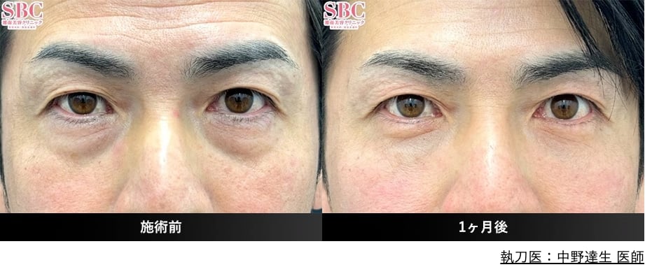 なぜ男性にクマ治療が人気なのか？