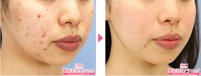 なぜ男性にニキビ・ニキビ跡治療が人気なのか？