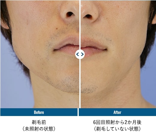 なぜ男性にヒゲ脱毛が人気なのか？