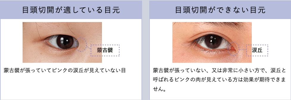 目頭切開プレミアム