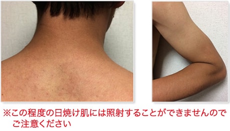 脱毛ができない肌の色はどのくらいですか？