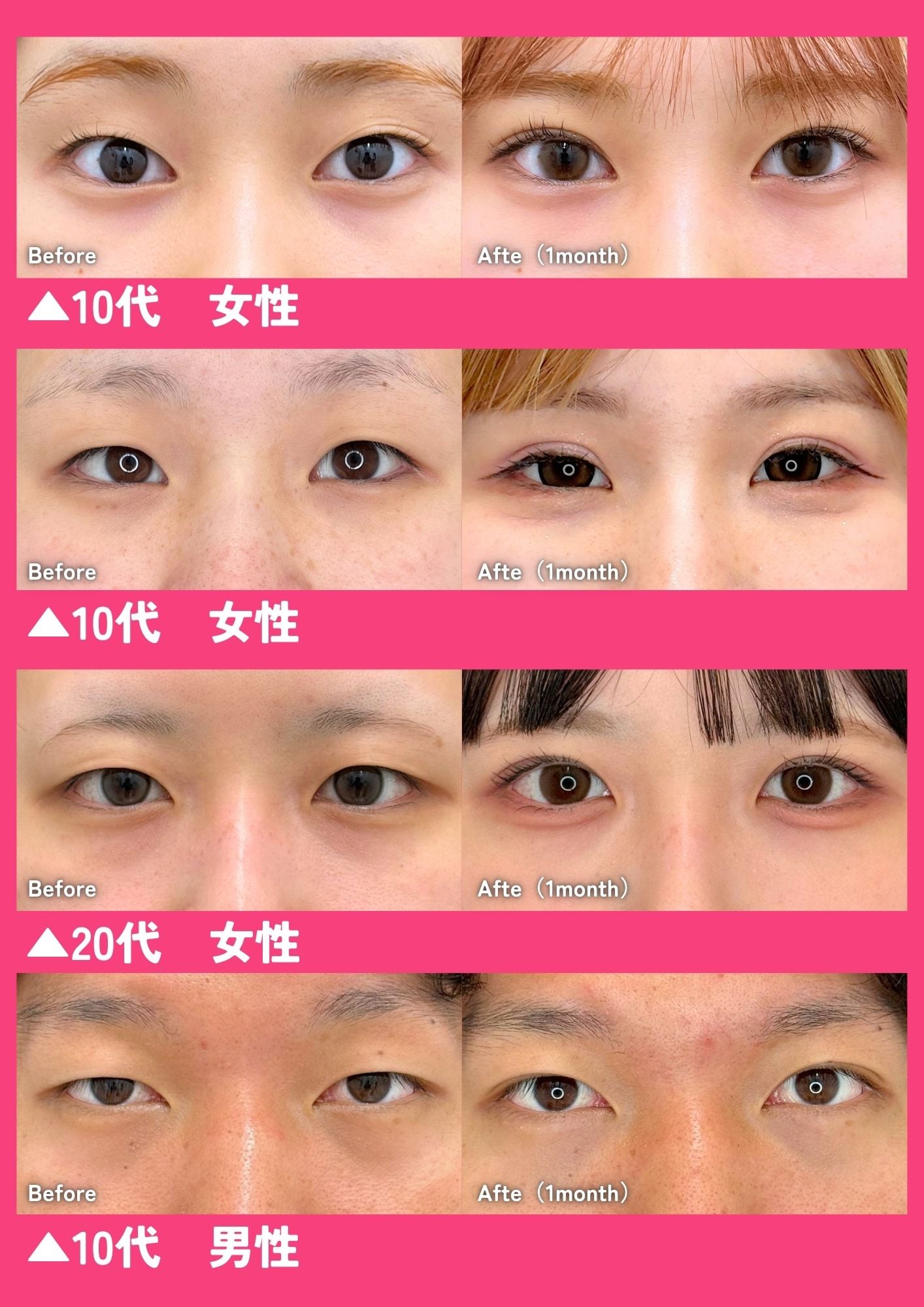 大分院医師の二重整形は綺麗！