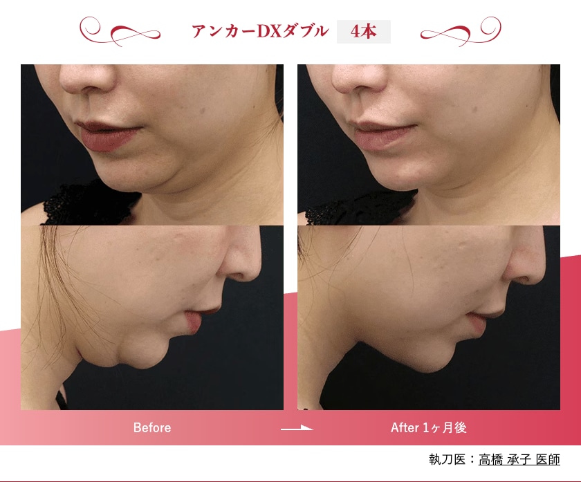 4本がオススメ！