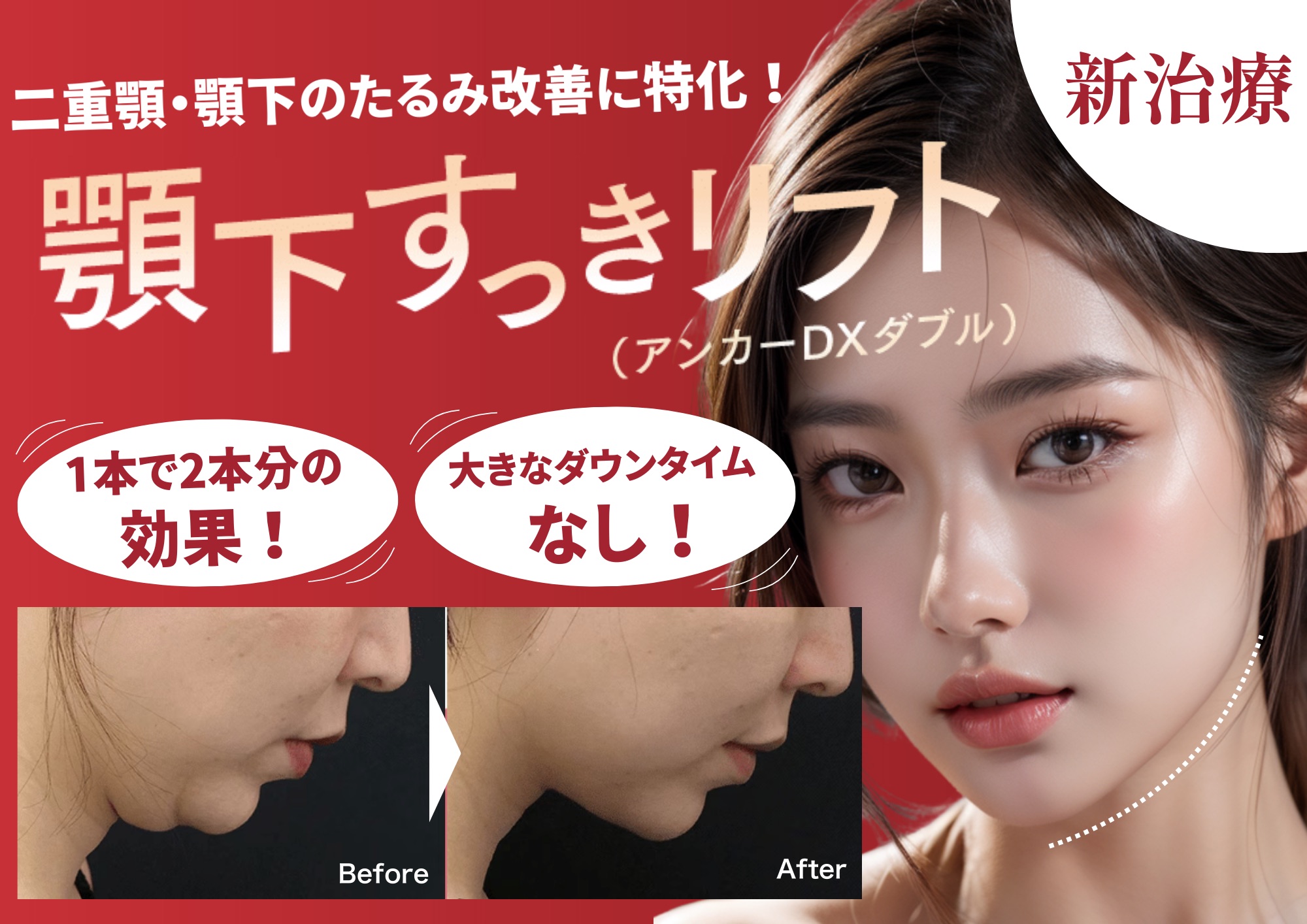 【小顔効果、脂肪吸引級の糸リフト】新治療の『顎下すっきリフト』が革命的すぎる【湘南美容クリニック大分院】