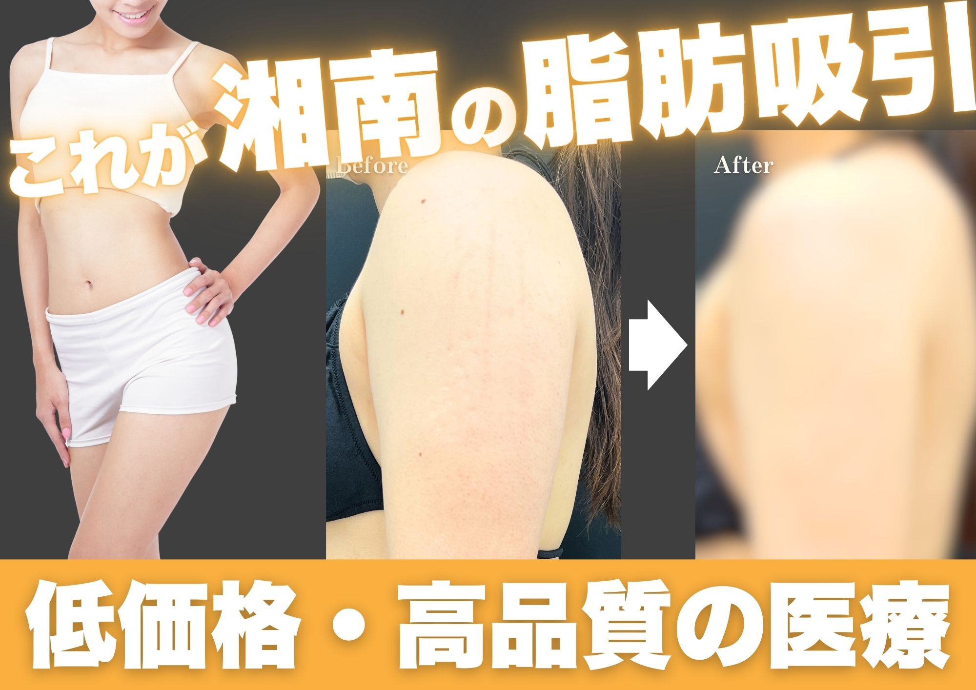 【脂肪吸引】美しいデザインで理想の身体を。