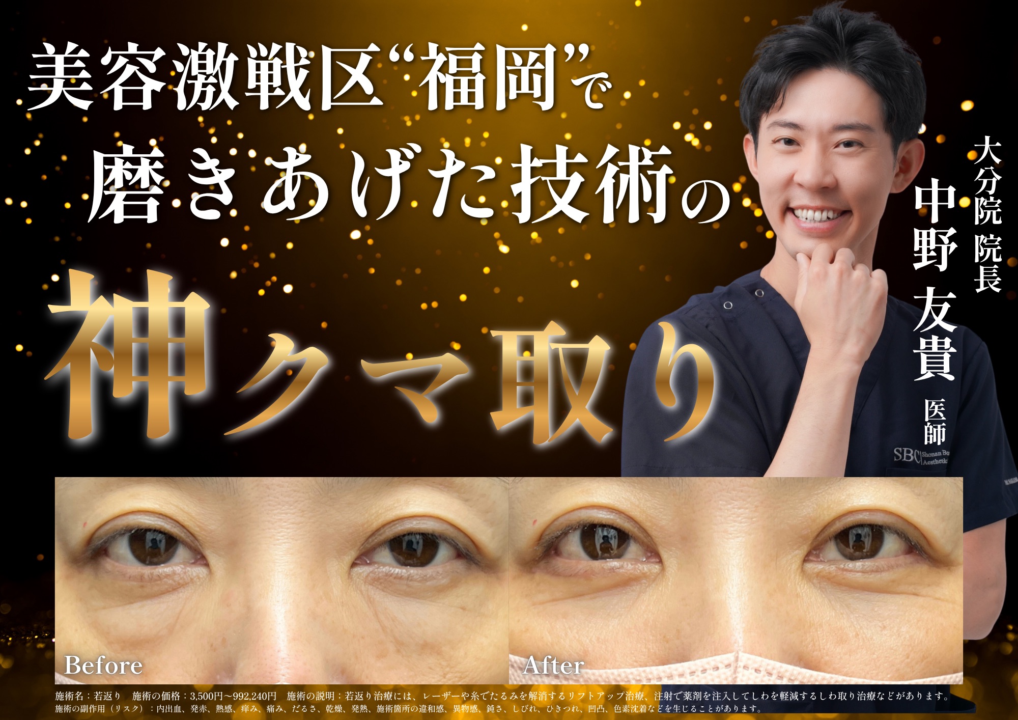 【クマ取り】目の下の膨らみ、色味改善で-10歳の目元に