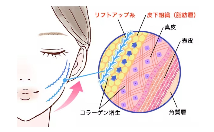 糸リフトとは？