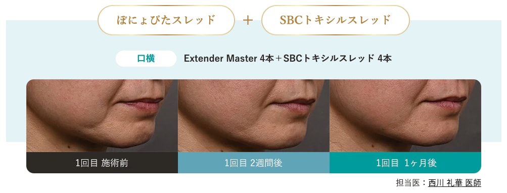 ぽにょぴたスレッド×SBCトキシルスレッド