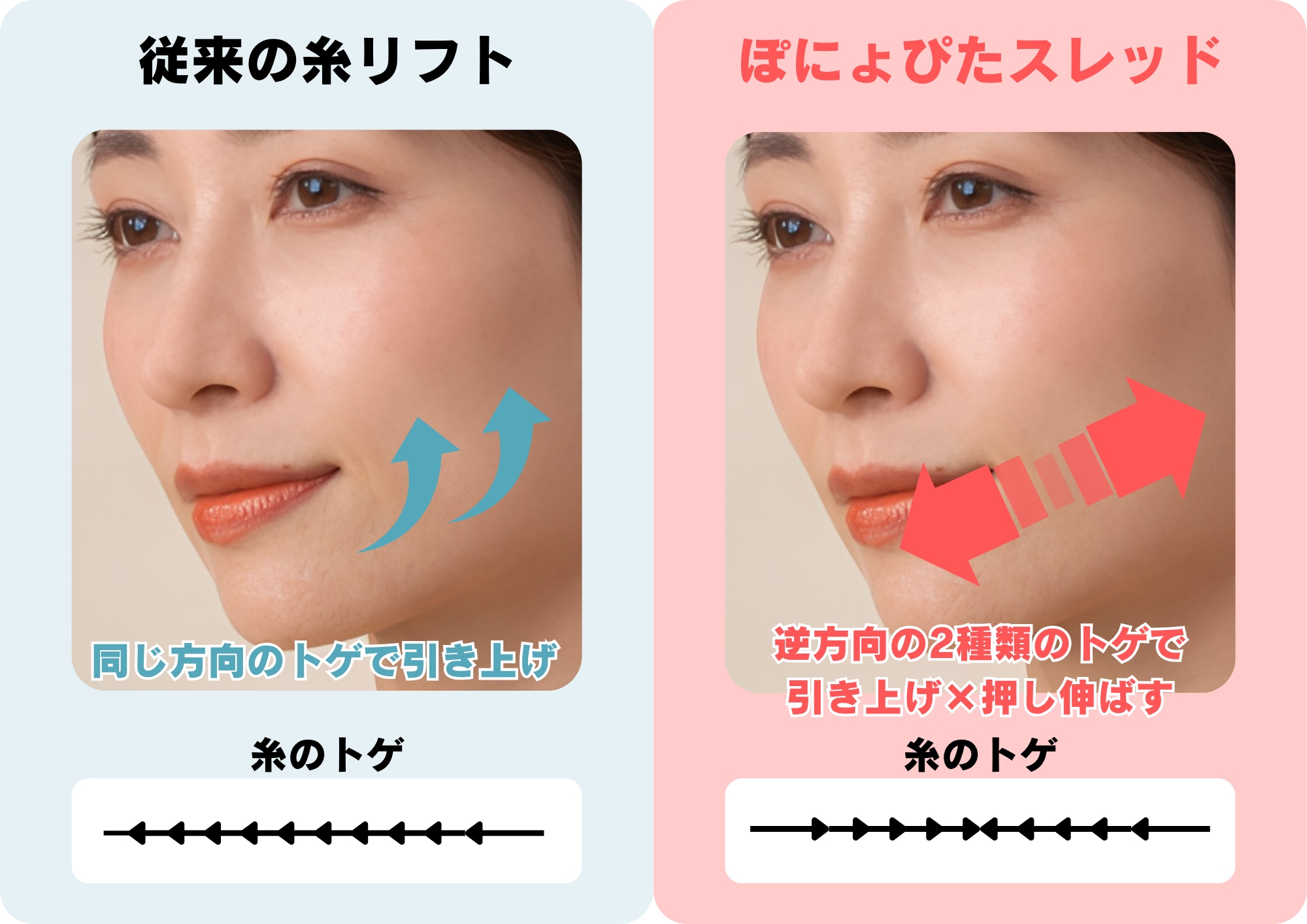 従来の糸リフトの違い