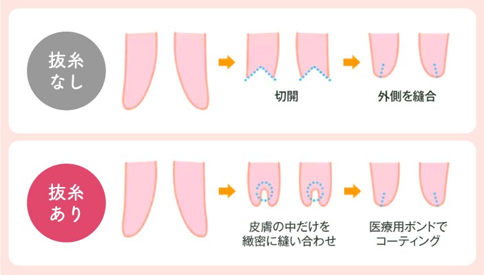 抜糸ありと抜糸なしの違い