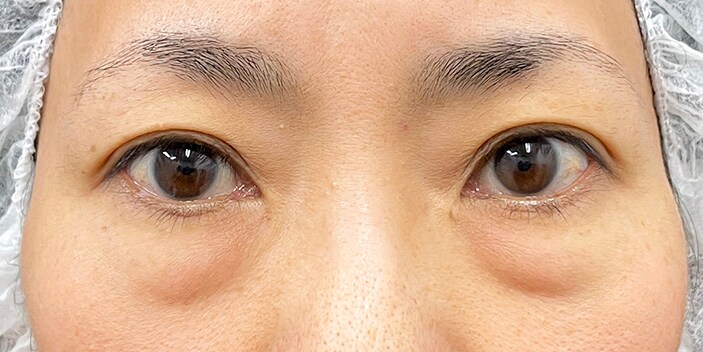 40代後半モニター様の症例
