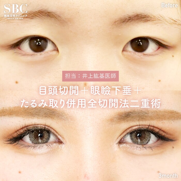 目頭切開プレミアム+眼瞼下垂+たるみ取り併用全切開法二重術