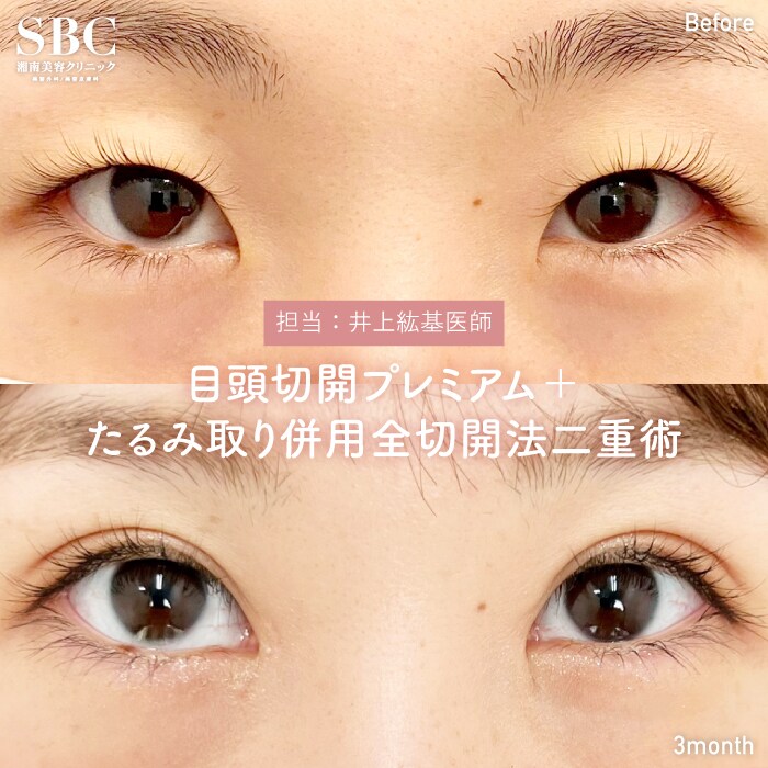 目頭切開プレミアム×全切開法二重術