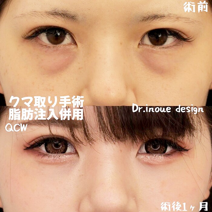埋没法×目の下の切らないクマ・たるみ取り