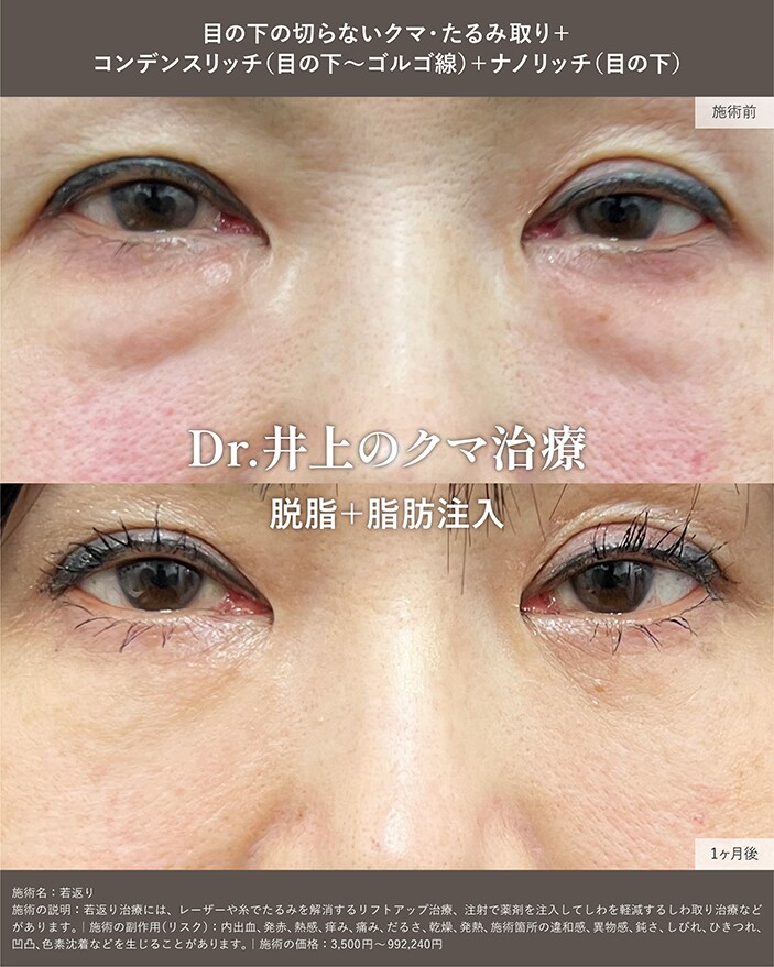 脱脂+脂肪注入
