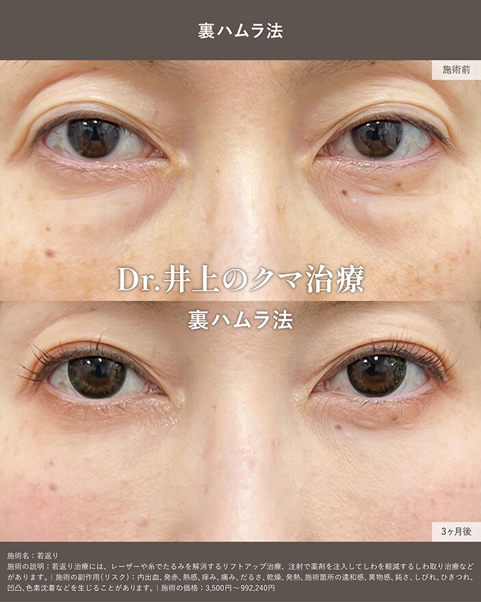 裏ハムラ法