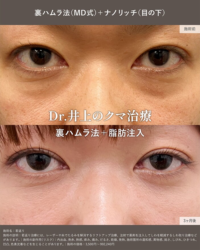 裏ハムラ法+脂肪注入