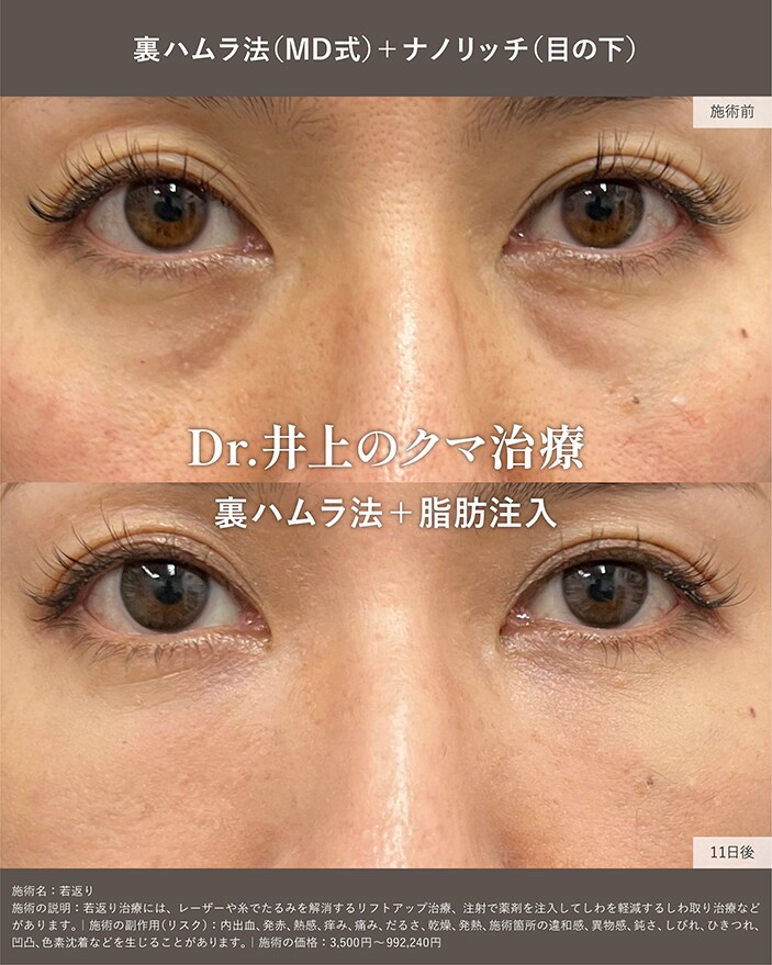 裏ハムラ法+脂肪注入