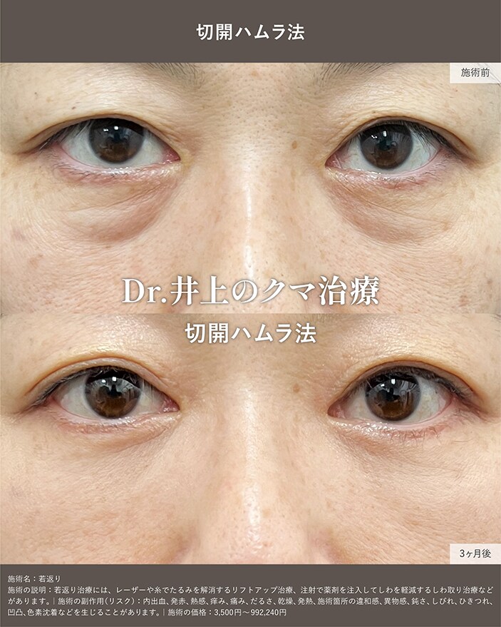 切開ハムラ法