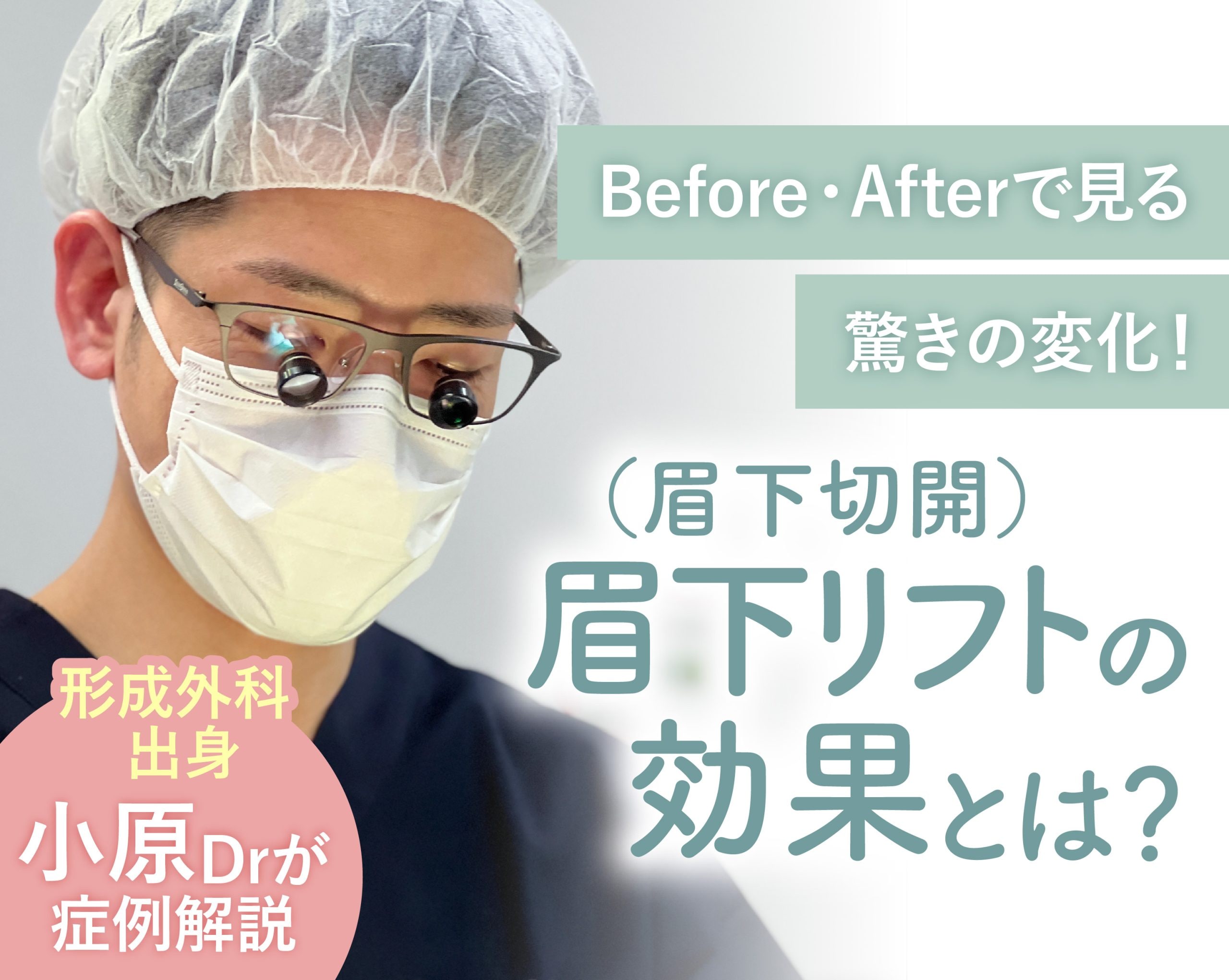 岡山で眉下リフト（眉下切開）ならSBC岡山院！Before・Afterで見る驚きの変化！