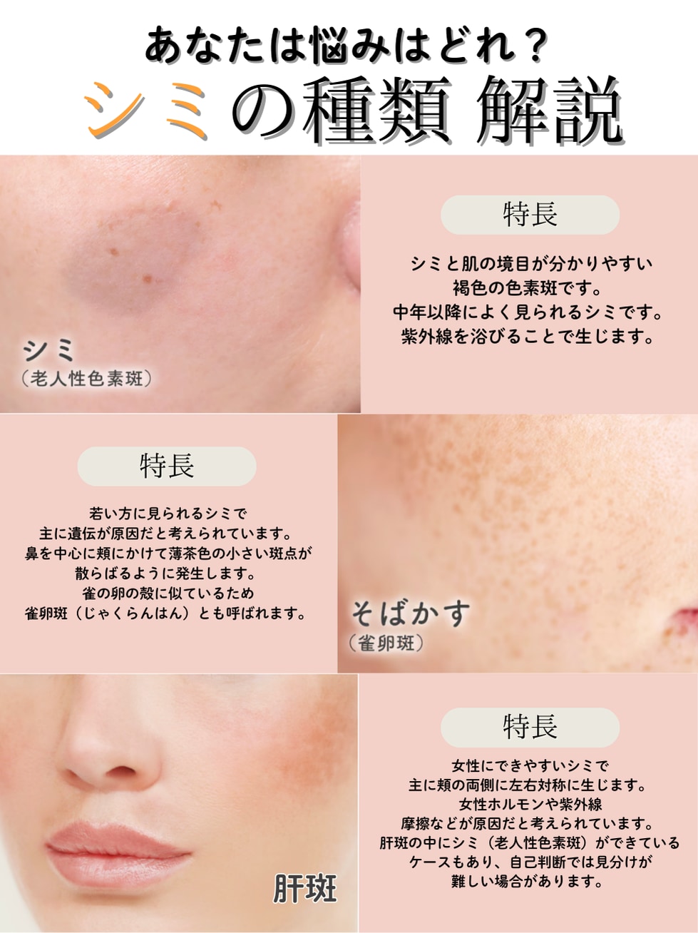 あなたのシミのタイプはどれ？