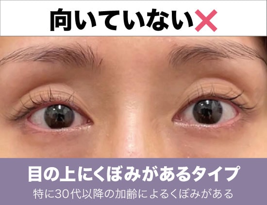 上まぶたの脂肪取りが向いていない人の特徴